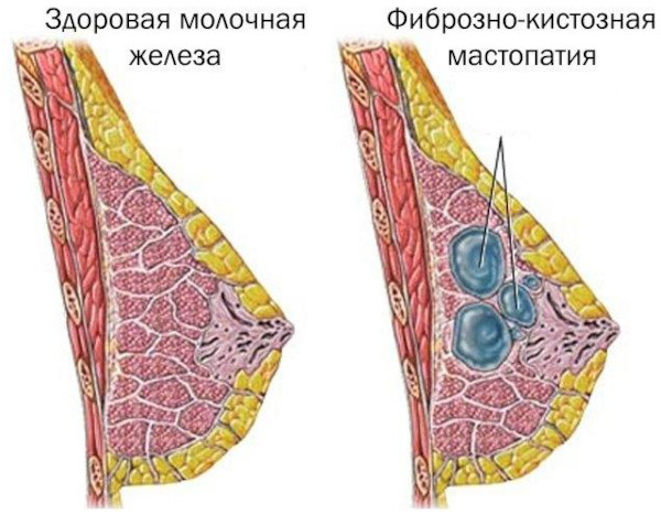 Болезненность молочных желез: жжение, покалывание, набухание. Причины
