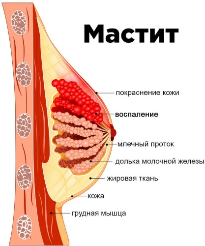 Почему чешутся соски у женщины. Причины зуда