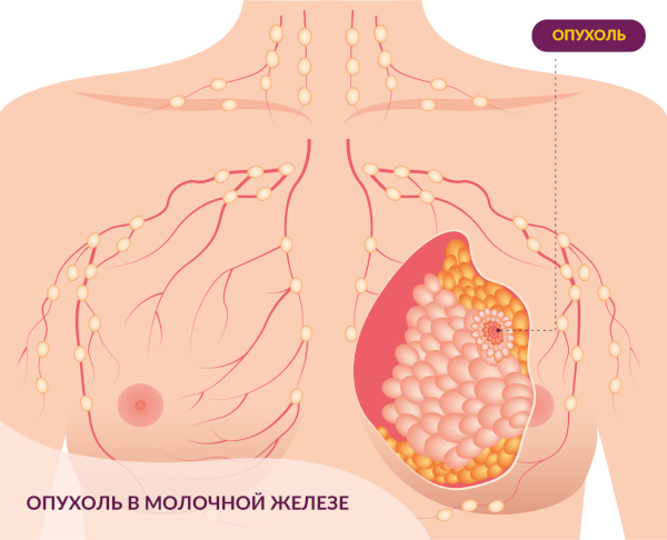 Болит молочная железа при надавливании сбоку. Причины у женщин