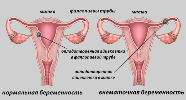 Болит спина при беременности на ранних сроках. Признаки, что делать
