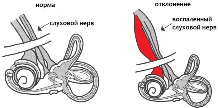 Болит ушная раковина снаружи, хрящ при надавливании, после сна. Лечение