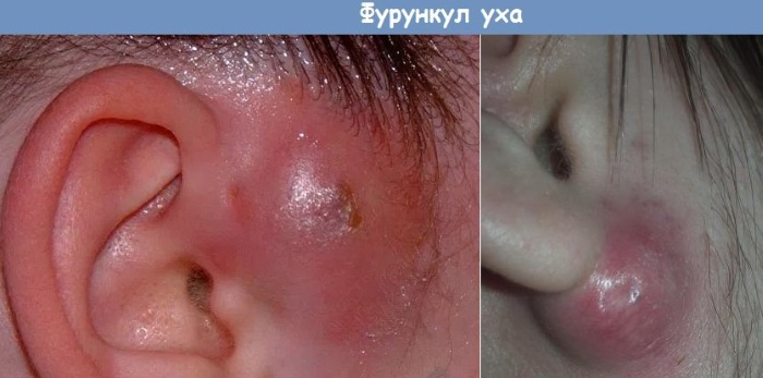 Болит ушная раковина снаружи, хрящ при надавливании, после сна. Лечение