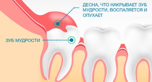 Болит ушная раковина снаружи, хрящ при надавливании, после сна. Лечение