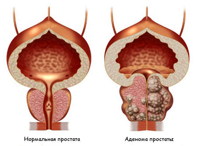 ПСА после радикальной простатэктомии. Норма, почему растет