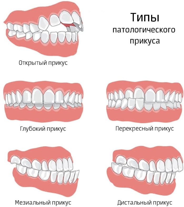 Пластины на зубы для детей для выравнивания. Цена, отзывы