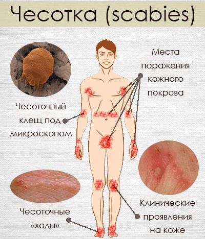 Сыпь при инфекционных заболеваниях. Виды, диагностика, как отличить у детей, взрослых, как лечить