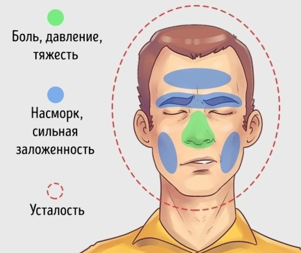 Cинусит и гайморит: разница воспаления носовых пазух, симптомы