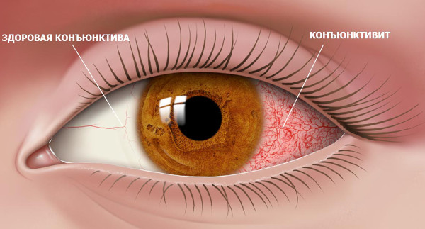 Дакриоцистит новорожденных. Фото, что это, массаж, лечение