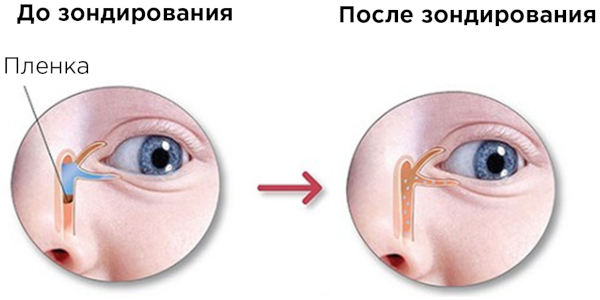 Дакриоцистит новорожденных. Фото, что это, массаж, лечение