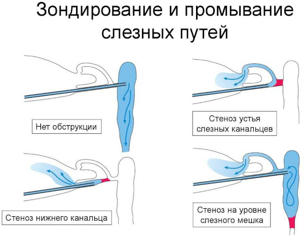 Дакриоцистит новорожденных. Фото, что это, массаж, лечение