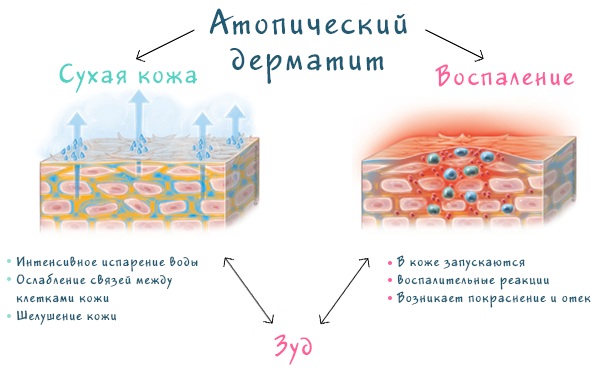 Почему чешутся соски у женщины. Причины зуда
