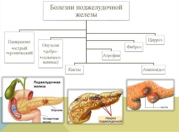 Диагностика поджелудочной железы. Анализы, как проверить