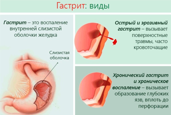 Стол №8. Диета при ожирении, меню на неделю, рецепты блюд для похудения. Таблица продуктов для детей и взрослых