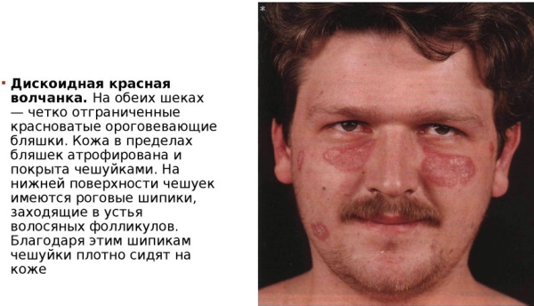 Дискоидная красная волчанка. Фото, диф.диагностика