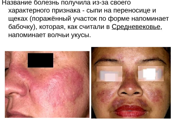 Дискоидная красная волчанка. Фото, диф.диагностика