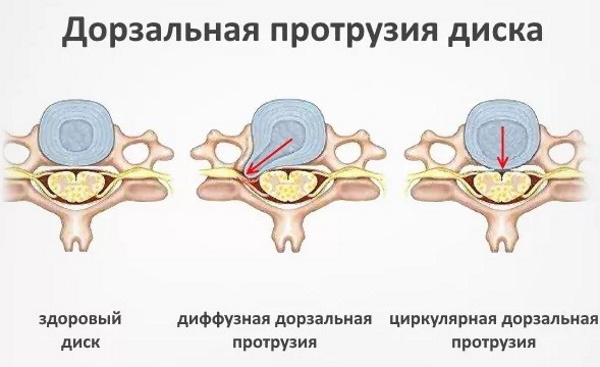 Упражнения (ЛФК) при протрузии поясничного отдела позвоночника