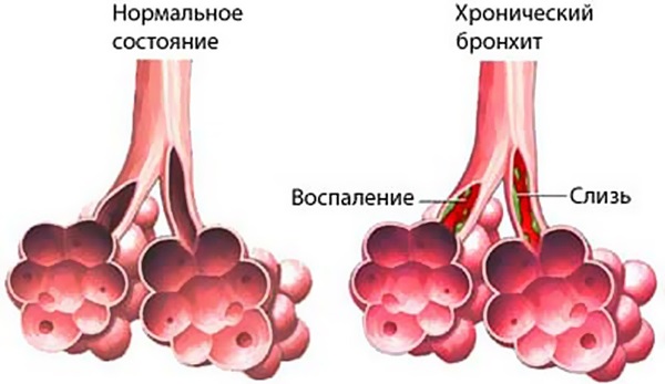 Дыхательная гимнастика при бронхите и болезни легких. Упражнения по Стрельниковой, Бутейко, Фролову