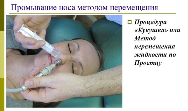 Экссудативный гайморит. Что это, лечение у взрослых без прокола