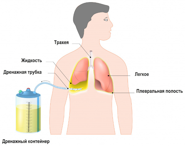 Экссудативный плеврит. Лечение, препараты, клинические рекомендации