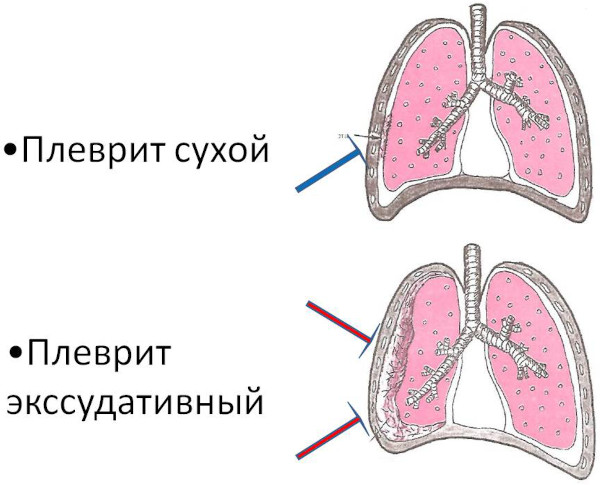 Экссудативный плеврит. Лечение, препараты, клинические рекомендации