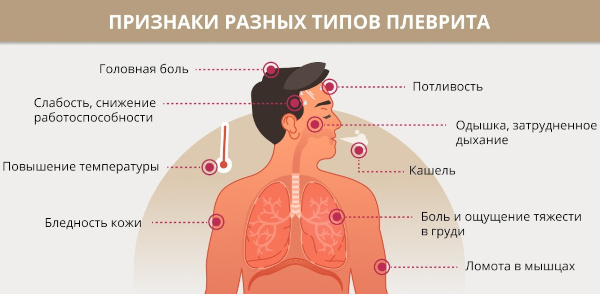 Экссудативный плеврит. Лечение, препараты, клинические рекомендации