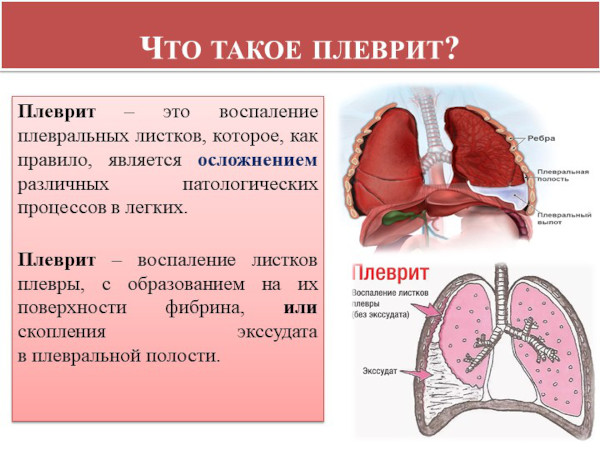 Экссудативный плеврит. Лечение, препараты, клинические рекомендации