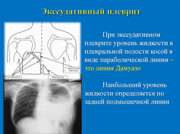 Экссудативный плеврит. Лечение, препараты, клинические рекомендации