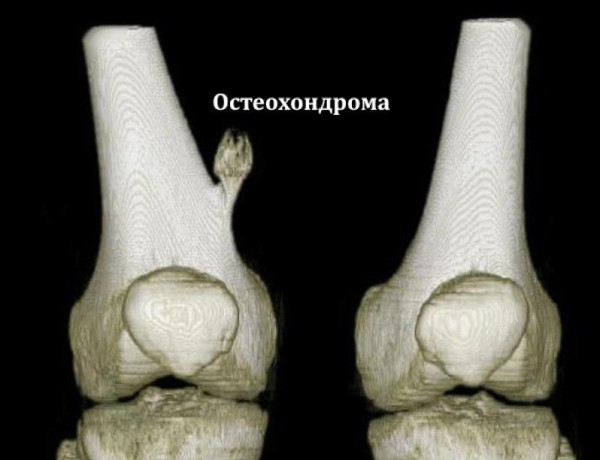 Экзостоз костно-хрящевой ткани. Лечение, что это такое