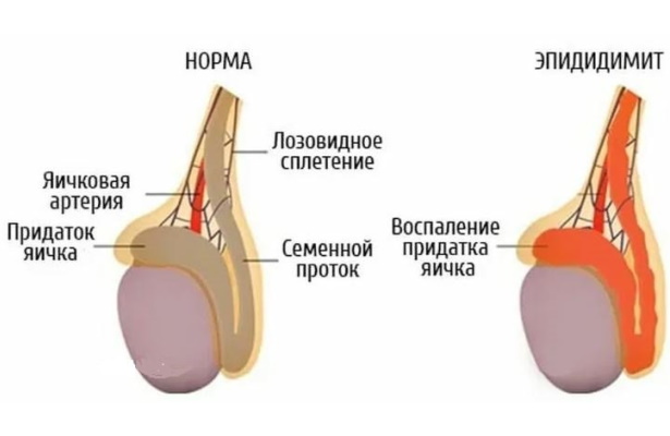 Азооспермия. Что это такое, лечится или нет