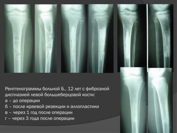 Фиброзная дисплазия бедренной (большеберцовой) кости. Что это, лечение