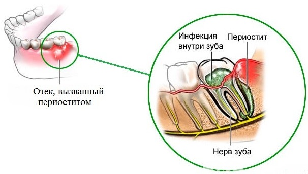 Флюс у ребенка 2-3-4 года. Фото, чем лечить