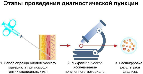 Галактоцеле молочной железы. Что это такое, лечение