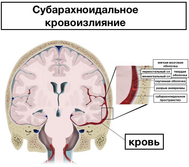 Инфаркт головного мозга и инсульт. Разница и отличия