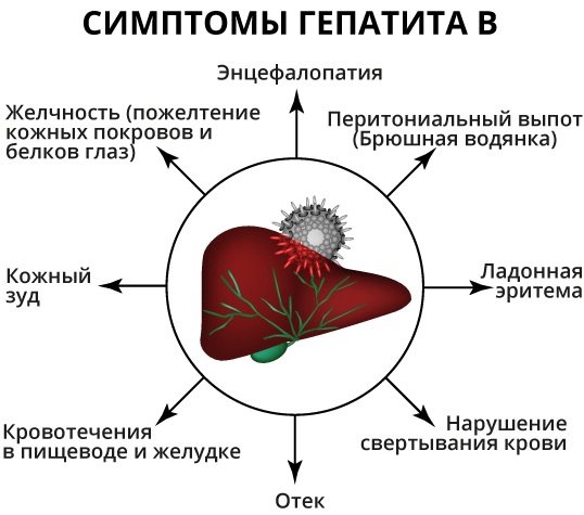 Невропатия (неврит) малоберцового нерва. Симптомы, лечение
