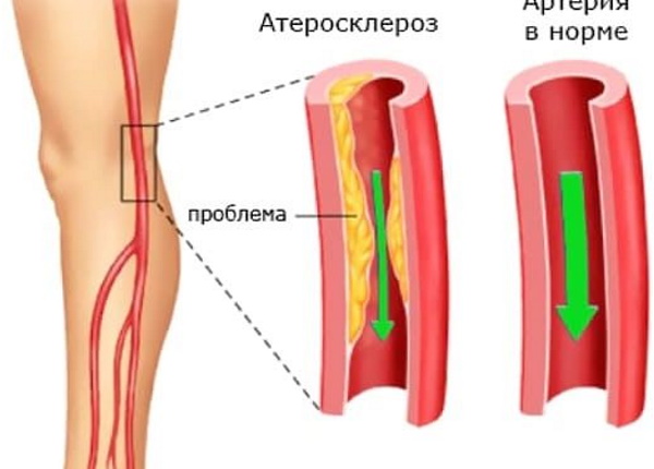 Дерматомиозит. Что это, диагностика, симптомы и лечение