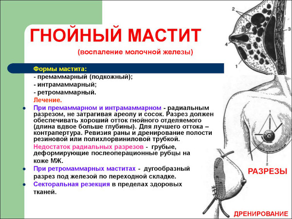 Гнойный мастит у женщин. Что это такое, лечение, фото