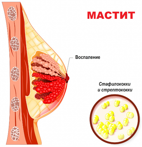 Гнойный мастит у женщин. Что это такое, лечение, фото