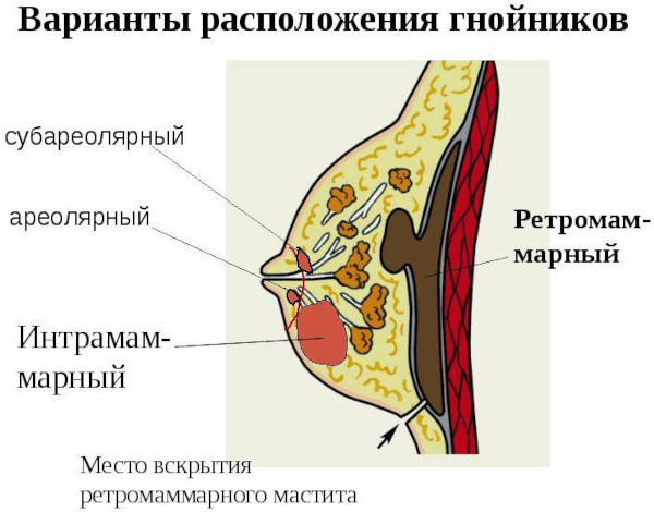 Гнойный мастит у женщин. Что это такое, лечение, фото