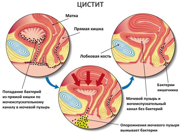 Гомеопатия при цистите у женщин: препараты и лечение