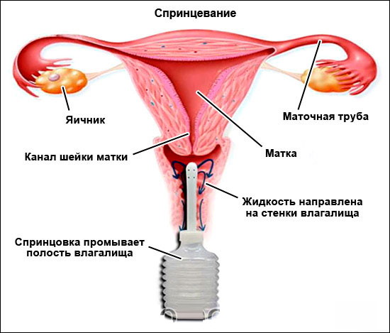 Груша для спринцевания гинекологические. Виды, какая лучше