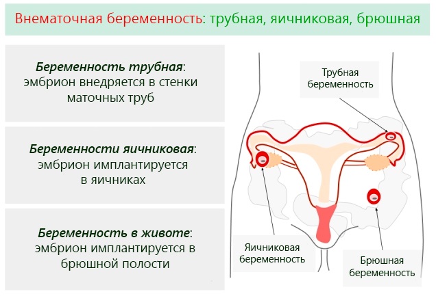 Боль в правой подвздошной области у женщин. Причины
