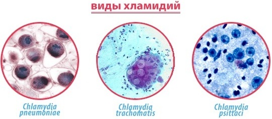 Хламидии у женщин. Симптомы и лечение, причины при беременности