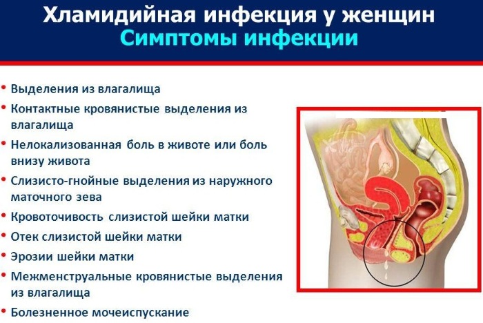 Хламидии у женщин. Симптомы и лечение, причины при беременности