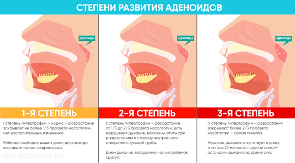 Хронический аденоидит у детей. Симптомы, лечение