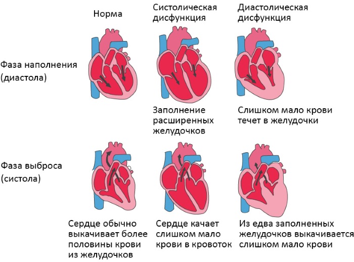 Признаки сердечной недостаточности. Симптомы у женщин, мужчин