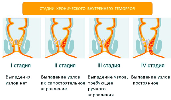Как понять, что у тебя геморрой. Симптомы внутреннего геморроя, температура