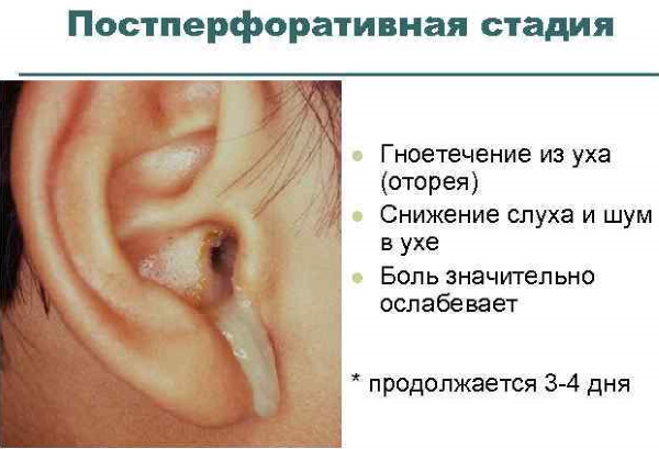 Как удалить воду из уха после бассейна, купания, промывания носа