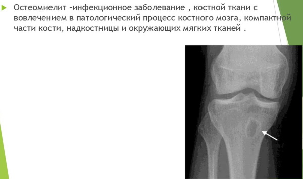 Как удлинить пальцы на руках в домашних условиях, операция