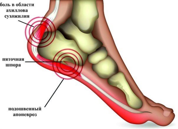 Подошвенный апоневроз стопы. Что это такое, симптомы, лечение