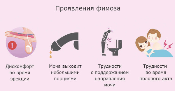 Кандидозный баланопостит у мужчин. Лечение, фото